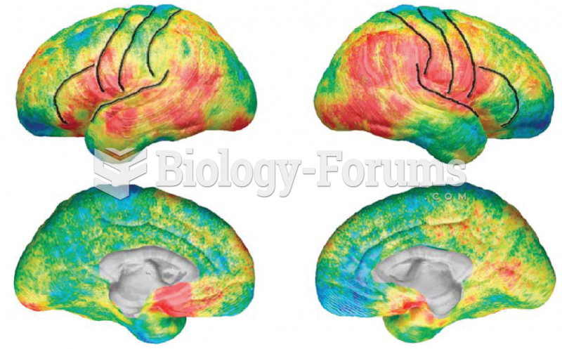 Structural MRIs reveal thinning of sensorimotor cortex in children with Tourette syndrome. Red and ...