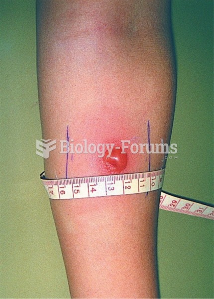 Induration measurement in a tuberculin skin test, a type IV hypersensitivity. 