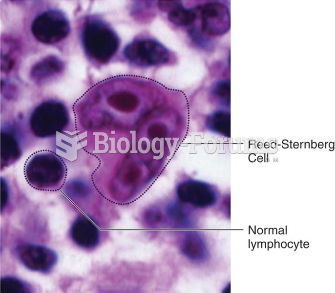 Reed-Sternberg cells are large, abnormal lymphocytes that may contain more than one nucleus. These ...