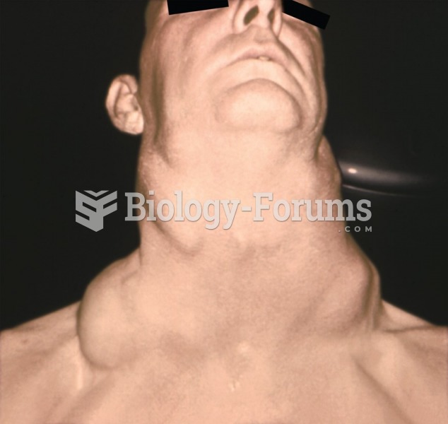Greatly enlarged cervical lymph nodes due to Hodgkin’s lymphoma. 