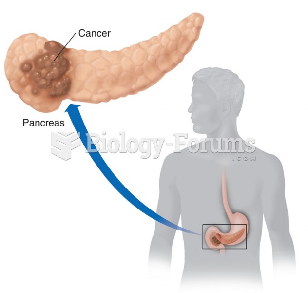 Pancreatic cancer. A common site of pancreatic cancer is in the head of the pancreas within the ...