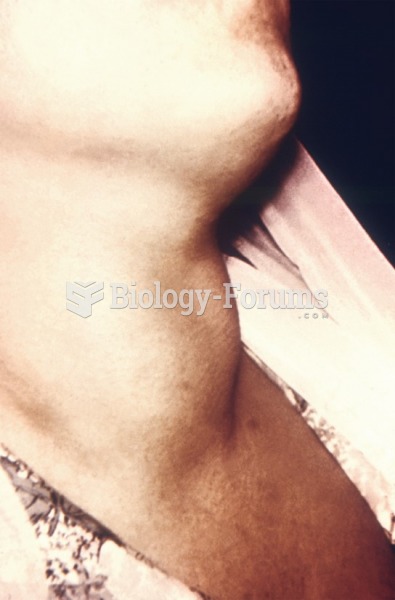 A patient with goiter due to iodine deficiency. 