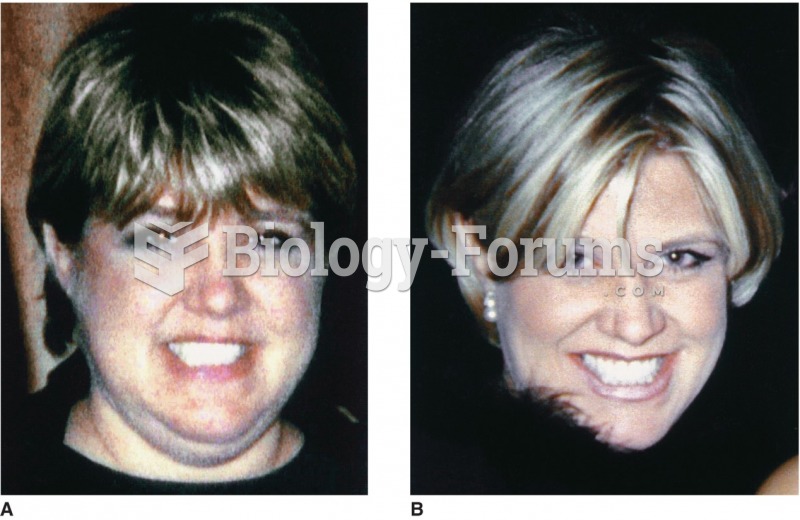 A patient with Cushing’s syndrome (A) before and (B) after receiving treatment. Sharmyn McGraw