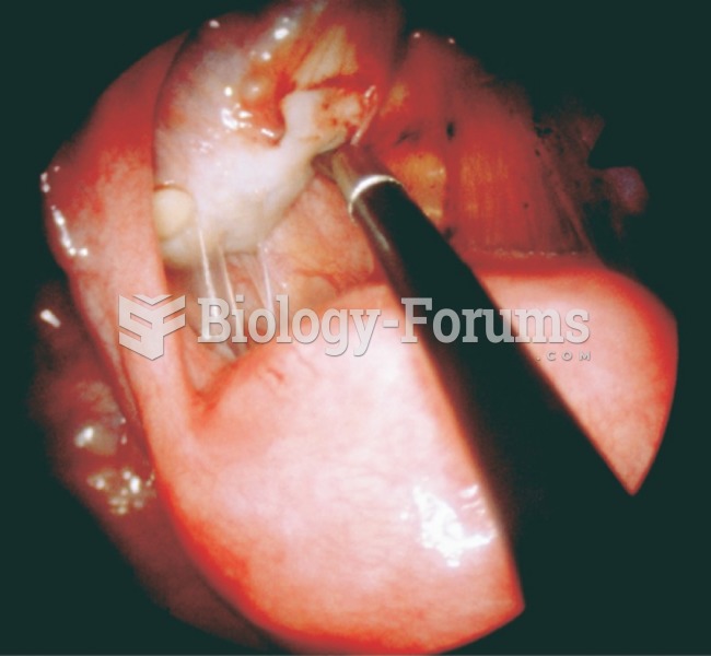 Photograph taken during a laparoscopic procedure. The uterus is visible below the probe, the ovary ...