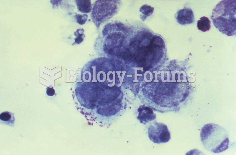 Gram-stained cervical smear. Note the gram-negative diplococci Neisseria gonorrhoeae ...