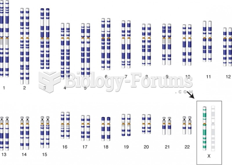 Karyotype for Turner’s syndrome (45, XO).