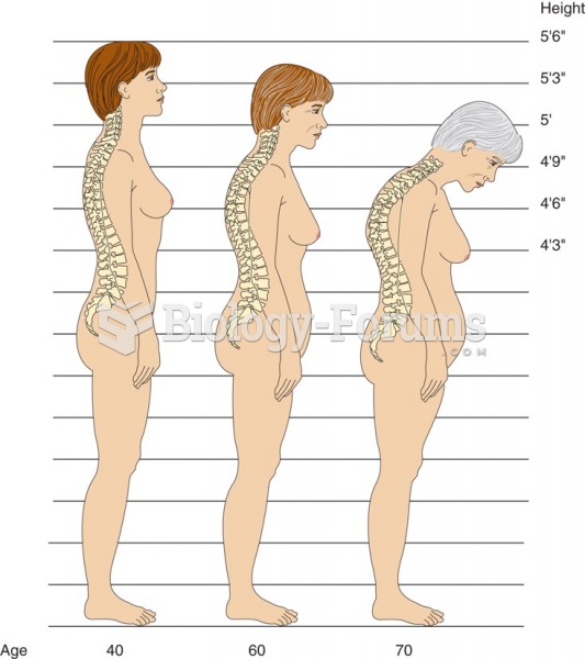 Spinal changes caused by osteoporosis.