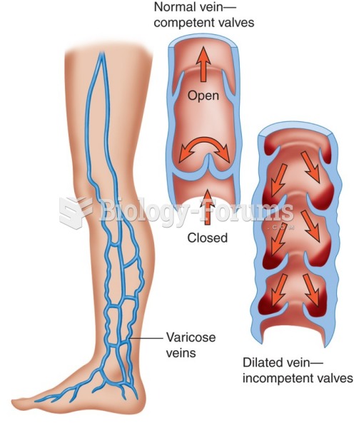 Development of varicose veins.