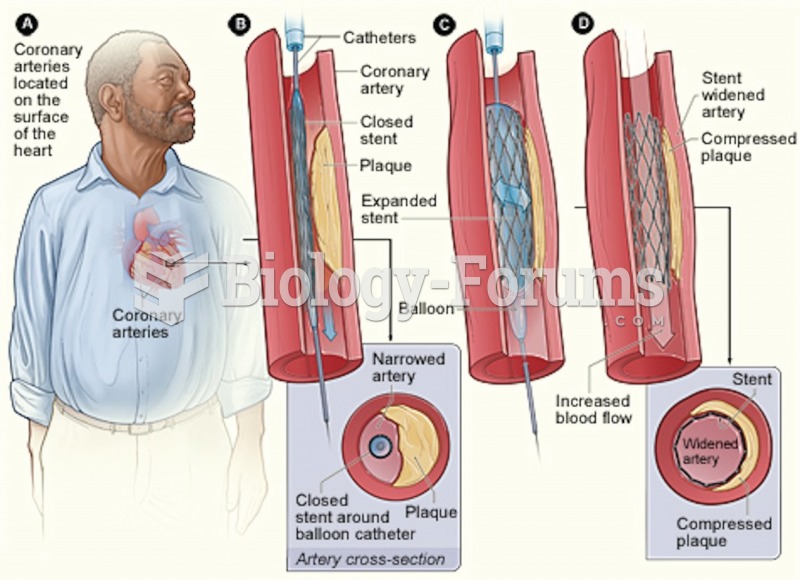 Angioplasty with stent placement. 