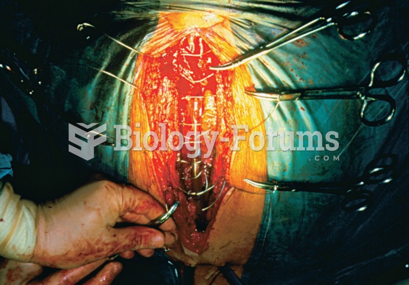 Bypass surgery of coronary blocked arteries. 