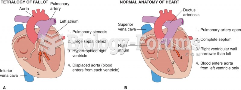 (A) Tetralogy of Fallot; (B) normal anatomy.