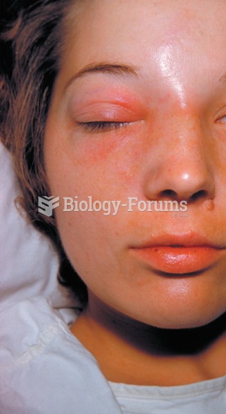 Cellulitis indicated by redness and swelling around the eye. 