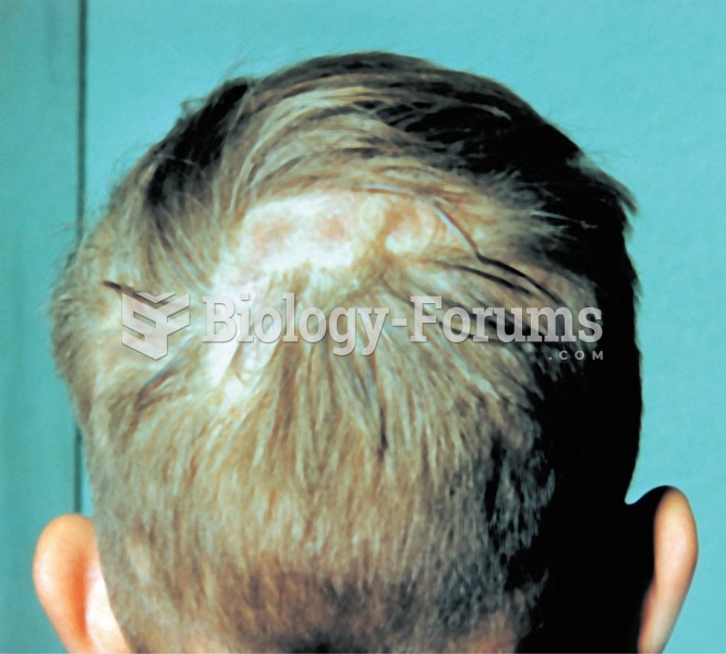 Tinea capitis, or scalp ringworm. 