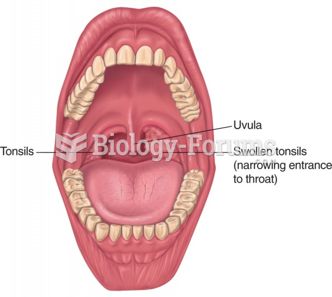 Normal and enlarged tonsils.