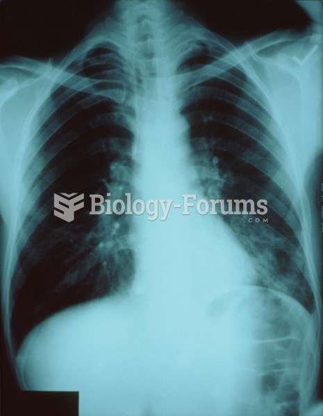 Pneumonia patient’s chest x-ray. Note the irregular areas of density.