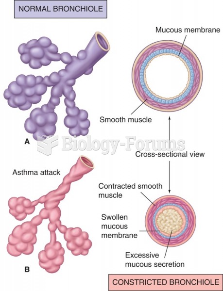 A) Normal bronchiole and (B) bronchiole constricted in asthma attack.