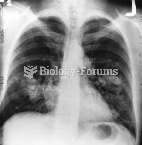 Chest x-ray of lung cancer; cancer is seen on the left side.