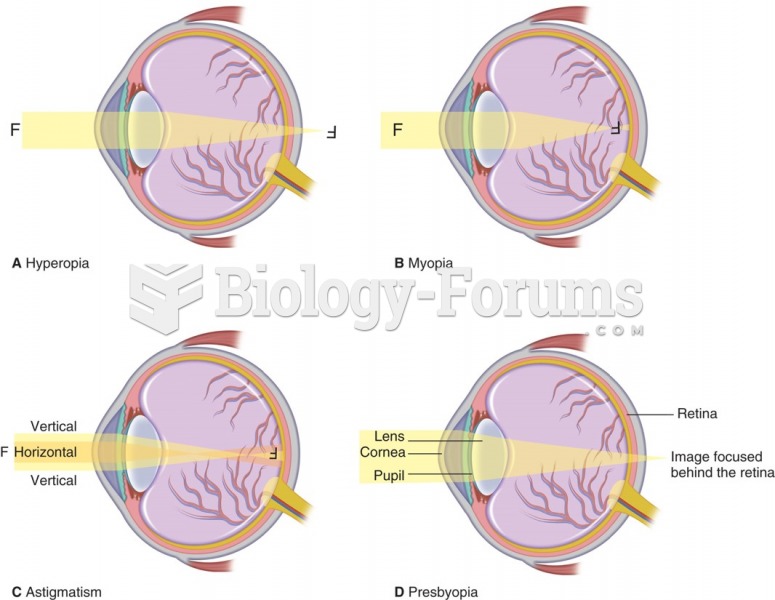 (A) In hyperopia, light rays focus behind the retina, making it difficult to focus on objects at ...