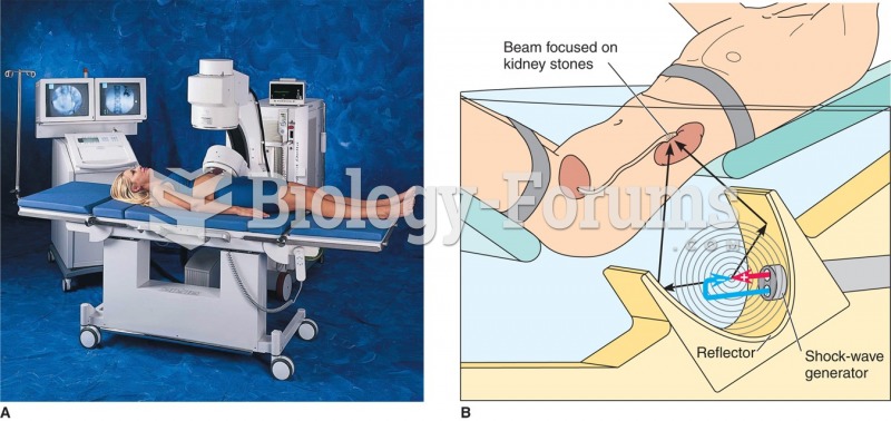 Extracorporeal shock-wave lithotripsy. Acoustic shock waves generated by the shock-wave generator ...