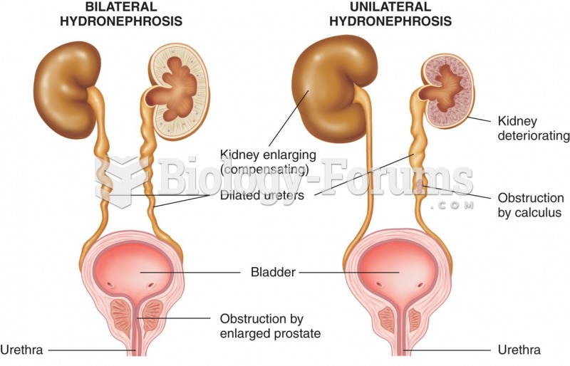 Hydronephrosis: bilateral (left), unilateral (right).