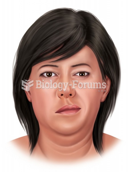 Bell’s palsy, showing typical drooping of one side of the face.