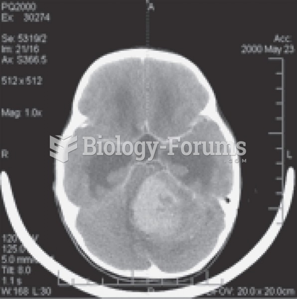 CT imaging of glioblastoma in a 6-year-old girl. 