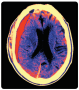 A CT scan of a subdural hematoma. Notice that the subdural hematoma has displaced the left lateral ...