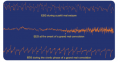 Cortical EEG recorded during epileptic attacks. Notice that each trace is characterized by epileptic ...