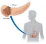 Pancreatic cancer. A common site of pancreatic cancer is in the head of the pancreas within the ...