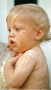 Measles rash. (© Lowell Georgia/Science Source/Photo Researchers, Inc.)
