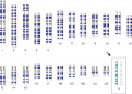 Karyotype for Turner’s syndrome (45, XO).