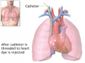 Cardiac catheterization.