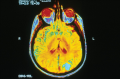 MRI image of brain cancer. The bright blue color indicates where the cancer has metastasized. 