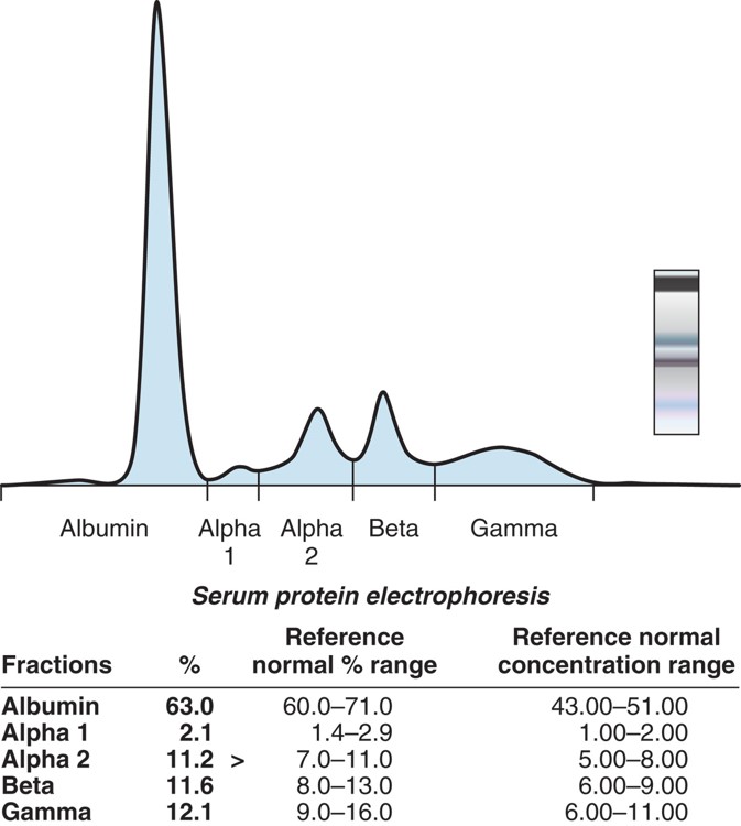 Serum protein electrophoresis is a technique in which serum components separate into 5 different ...