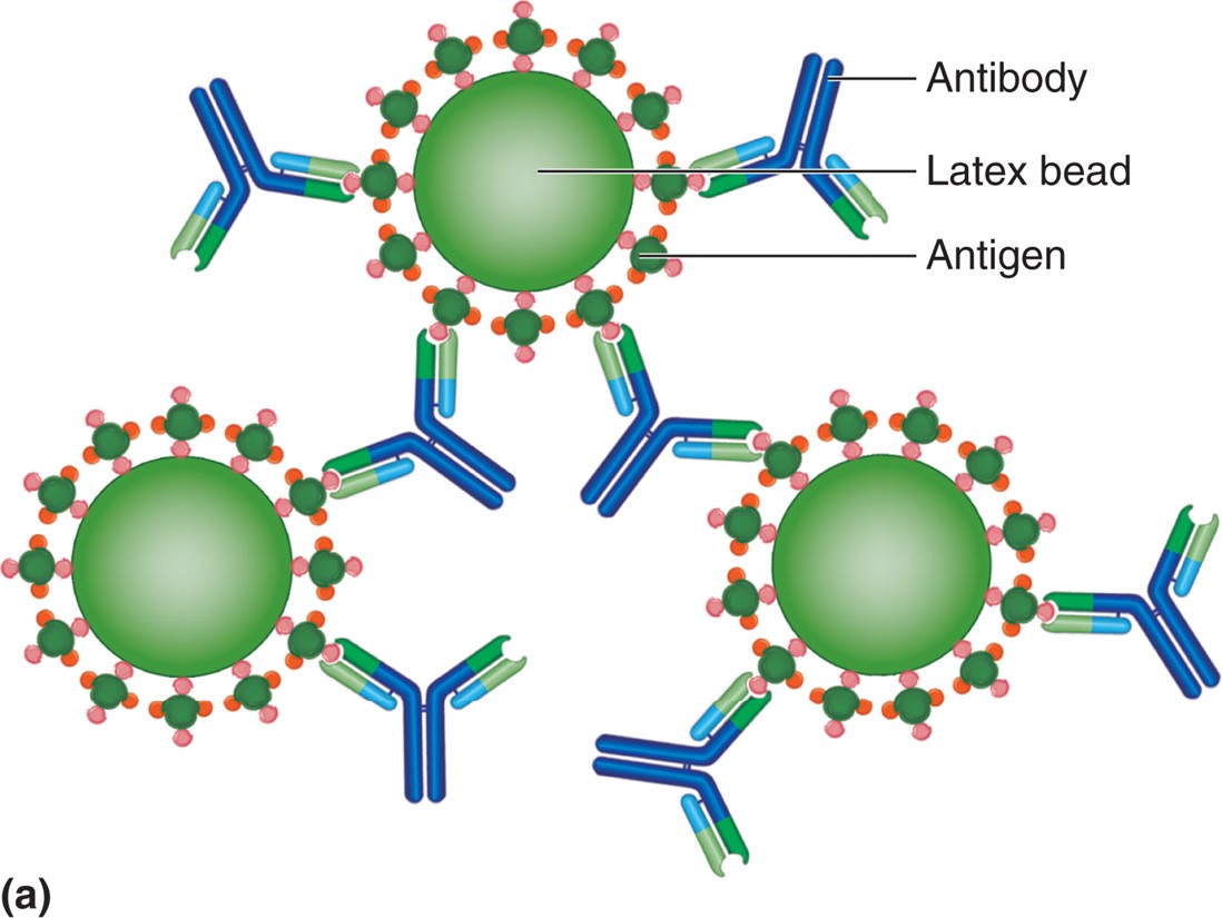 An agglutination reaction. Antigen-coated latex beads are held together by antibody. In a direct ...