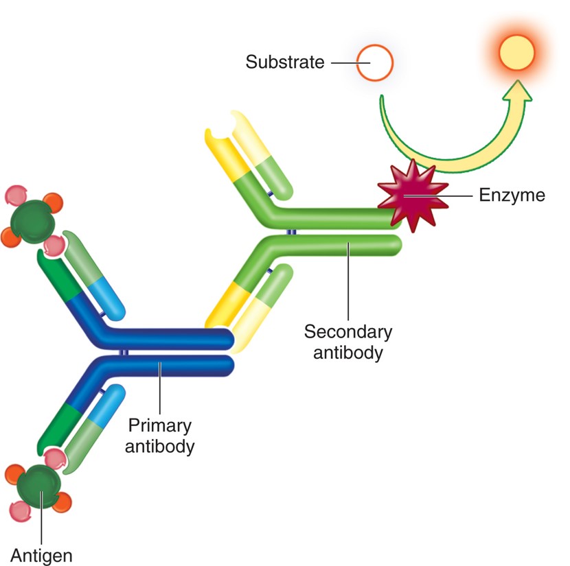 Indirect enzyme immunoassay. A patient's antibody reacts with the antigen, which is detected ...