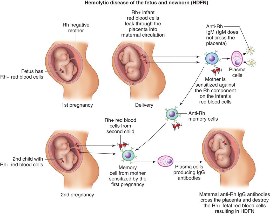 Erythroblastosis fetalis.