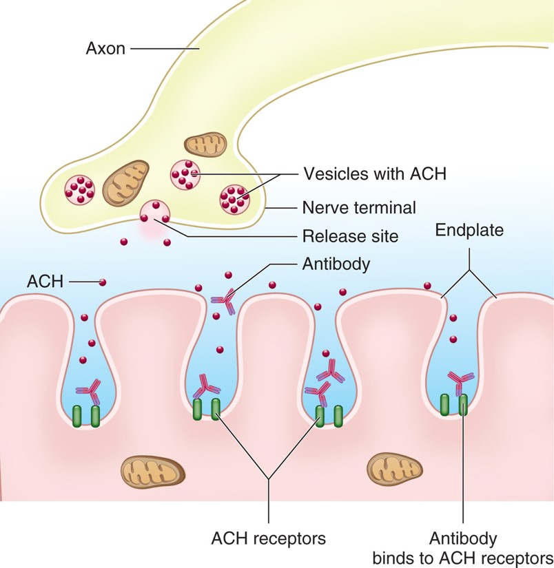 Antibodies in myasthenia gravis block the acetylcholine receptors at the neuromuscular junction