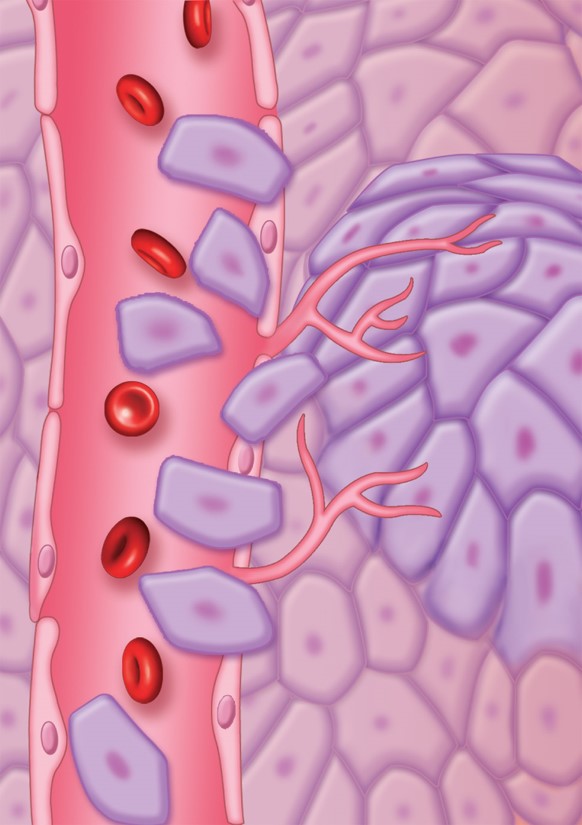 Metastatic process: Tumor leaving primary site to travel to other distant organs to grow.