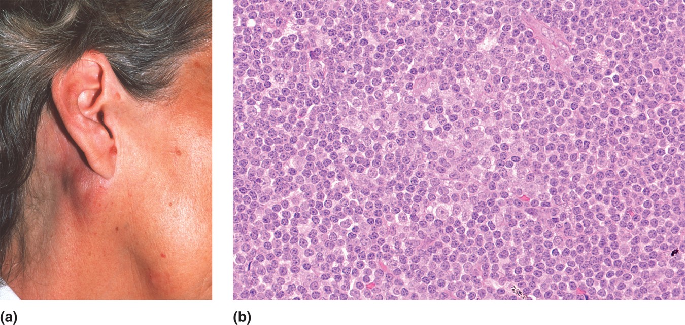 (a) Lymphoma. (b) Non-Hodgkin's lymphoma. 