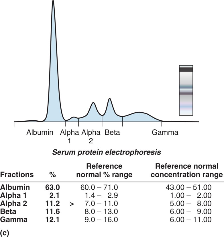 Electrophoresis gel in a densitometer. SPE densitometry showing a normal pattern.