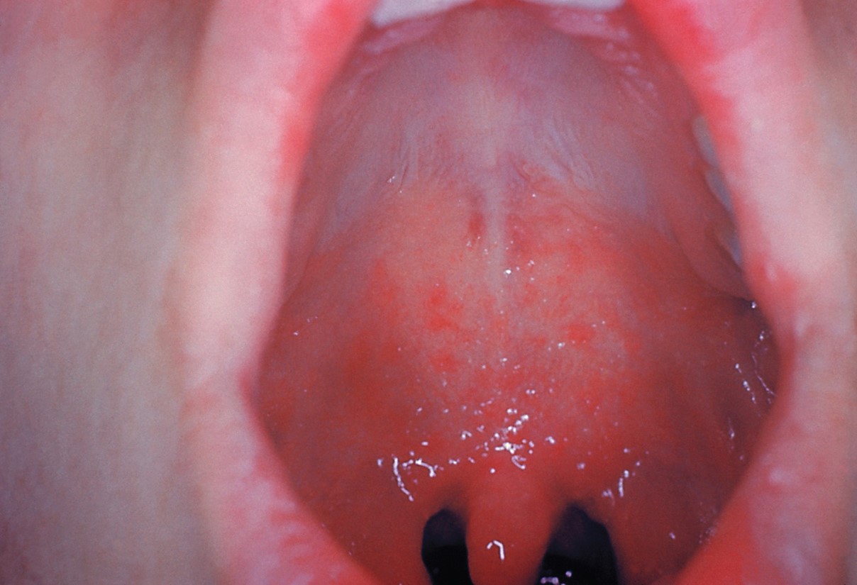 Koplik spots in the mouth of a patient with measles. 