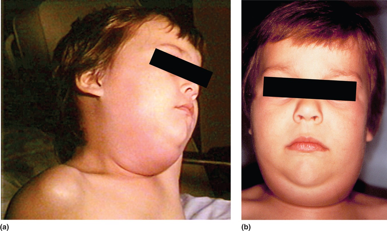 Mumps swelling of the salivary glands. 