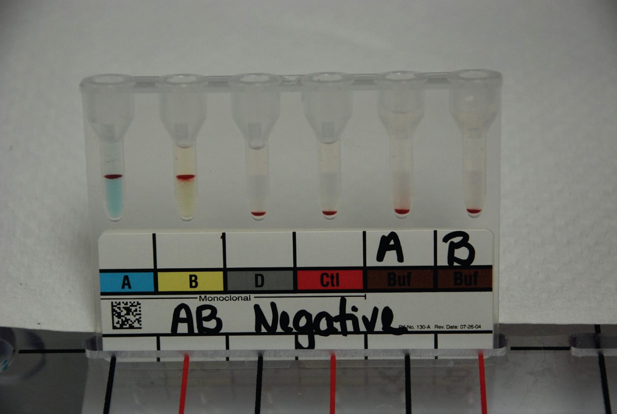 ABO and Rh grouping using gelatin centrifugation. The blood sample above is AB negative as indicated ...