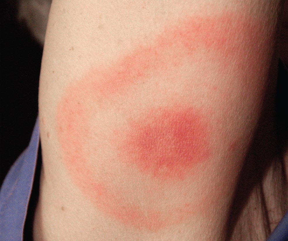 Erythematous rash in Lyme disease in the pattern of a "bull's-eye" at the site of ...