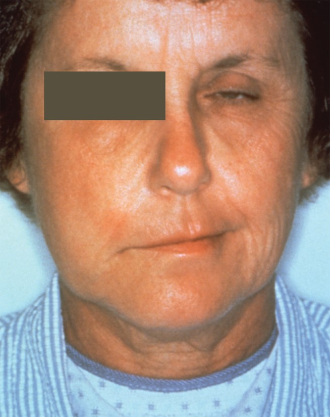 This patient presented with a case of facial palsy caused by an infection by the bacterial ...