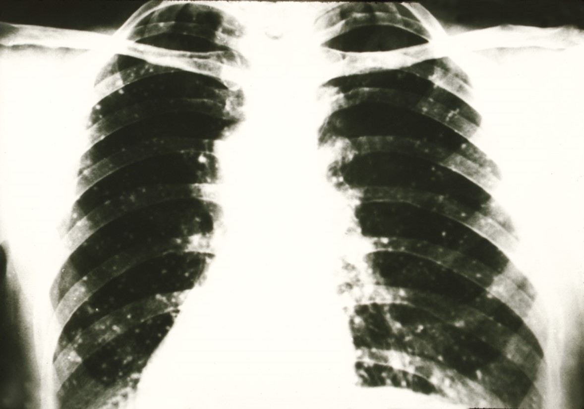 Lungs showing appearance of acute histoplasmosis infection. 