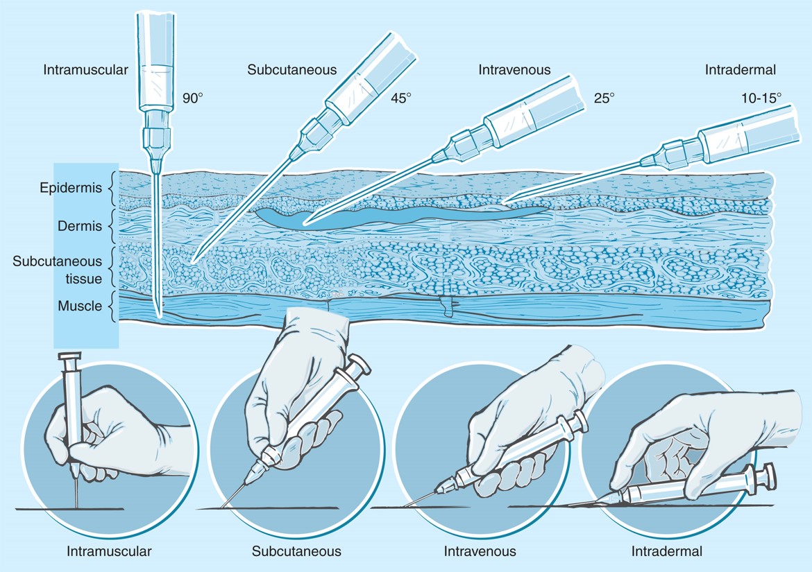 Different routes of parenteral drug administration.