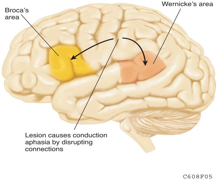 Diagram Showing How Conduction Aphasia is Caused