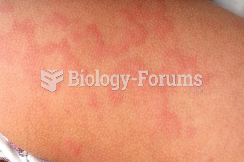 Uticaria, a skin rash caused by type I hypersensitivity.